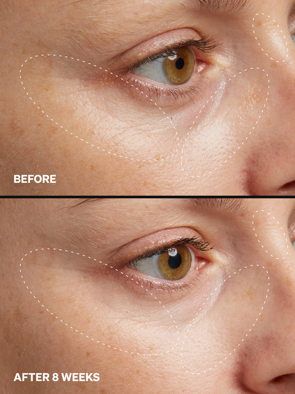 HPR Retinoid 0.3%