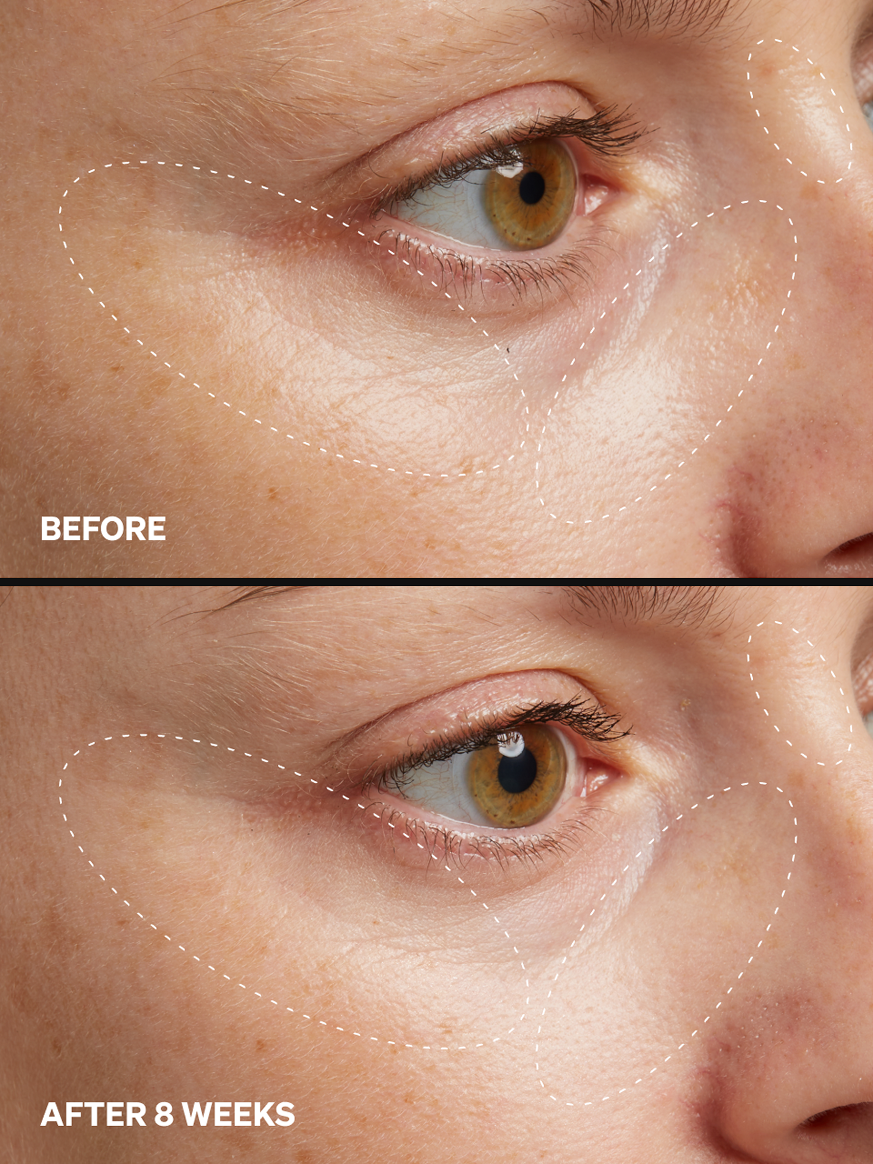 HPR Retinoid 0.3%