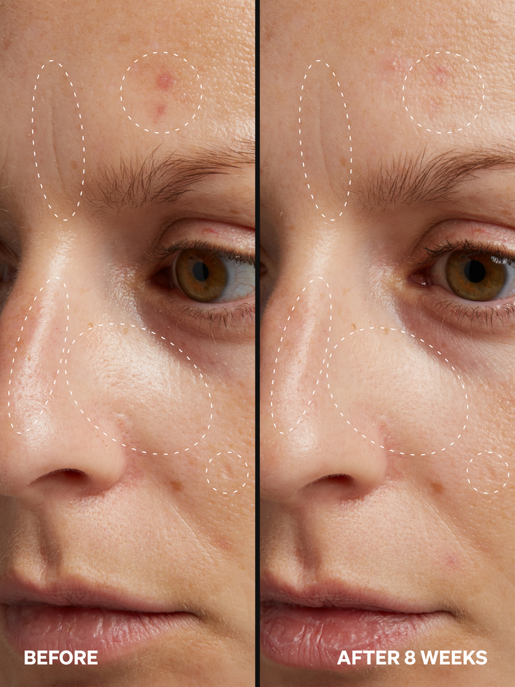 HPR Retinoid 0.3%