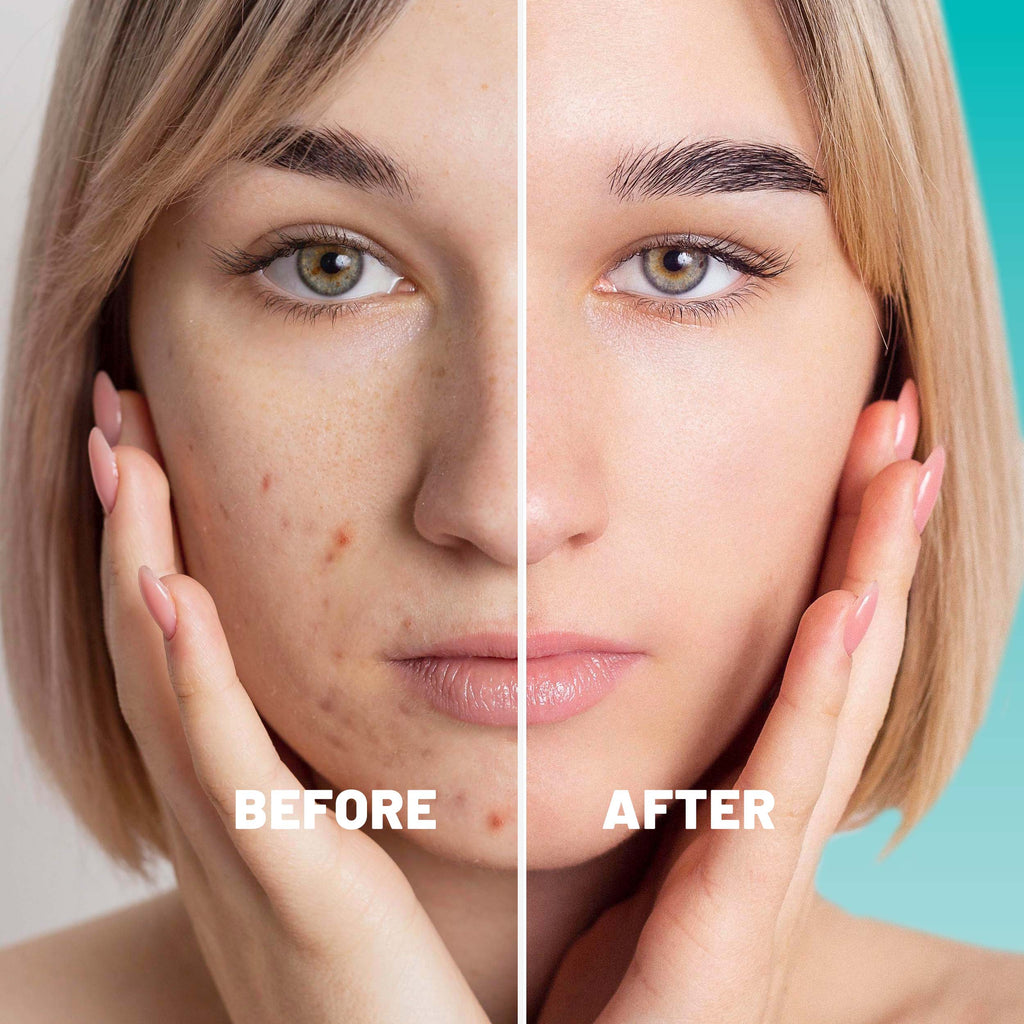 Microdarts Patches Targeted Blemish & Skin Support with Hyaluronic Acid, Salicylic Acid & Niacinamide, 18 Patches